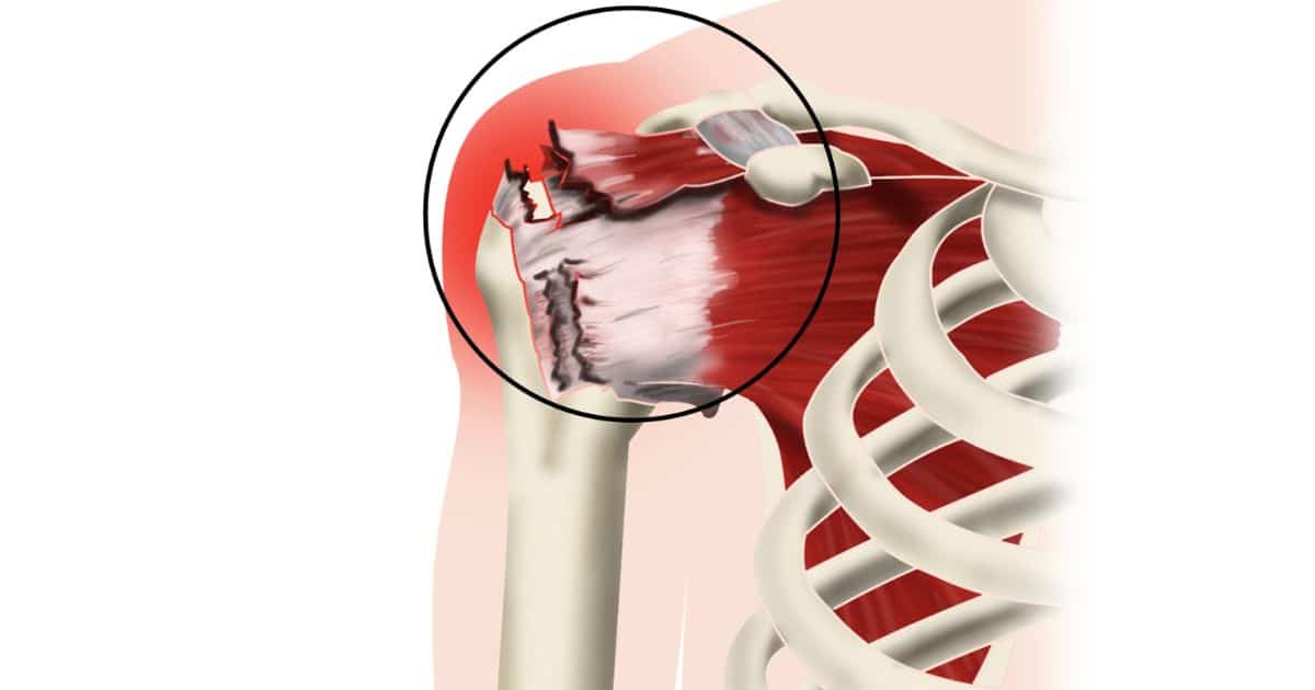Can You Play Golf Three Months After Rotator Cuff Surgery
