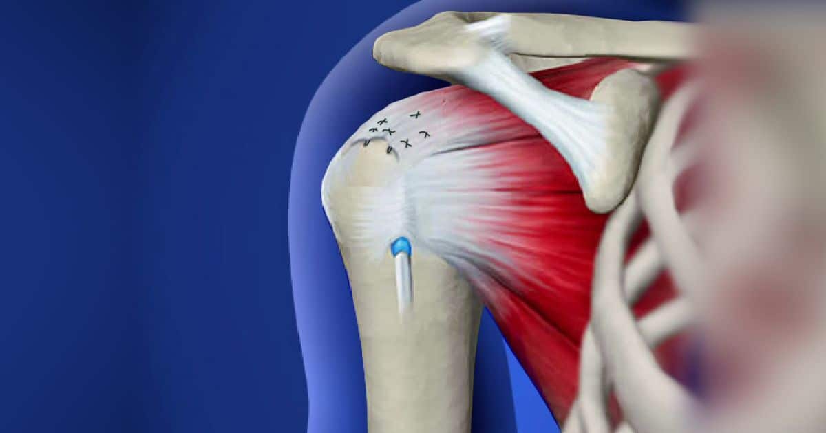 Factors to Consider Before Returning to Golf After Rotator Cuff Surgery